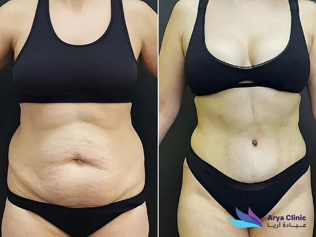 best liposuction clinic