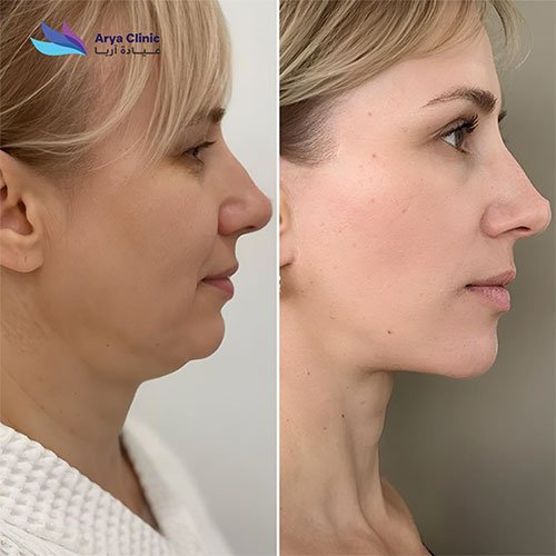 double chin removal dubai
