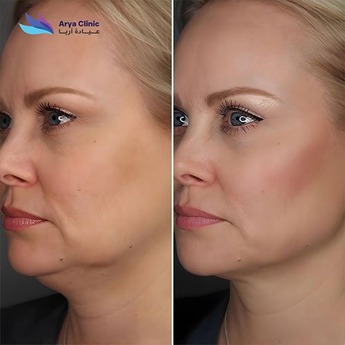 double chin removal treatment