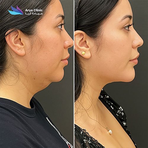 double chin removal