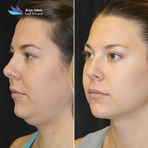 double chin removal treatment