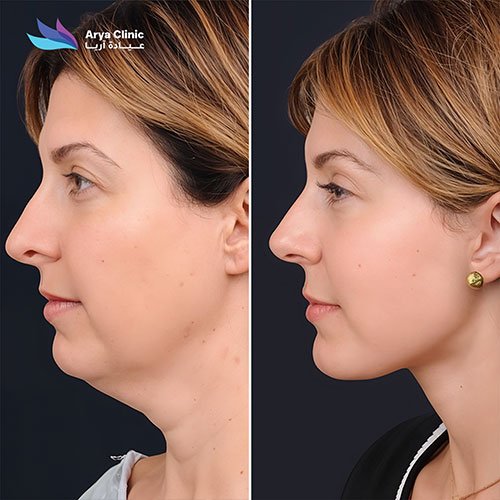 double chin removal treatment