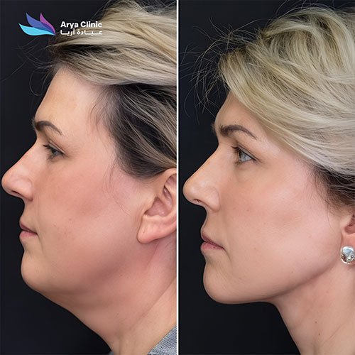 double chin liposuction