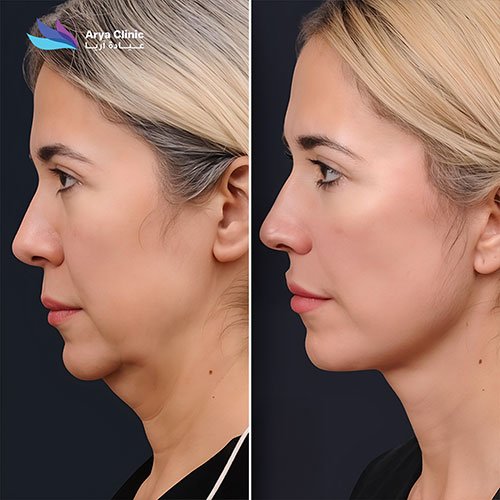 double chin liposuction