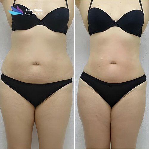 endolift-treatment-body