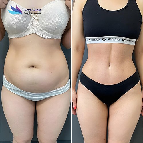 endolift-treatment-for-body