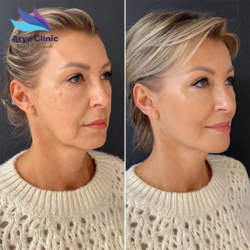 endolift-treatment-in-dubai