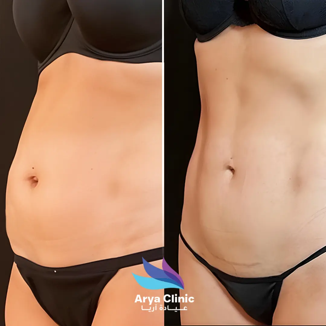 lipo treatment