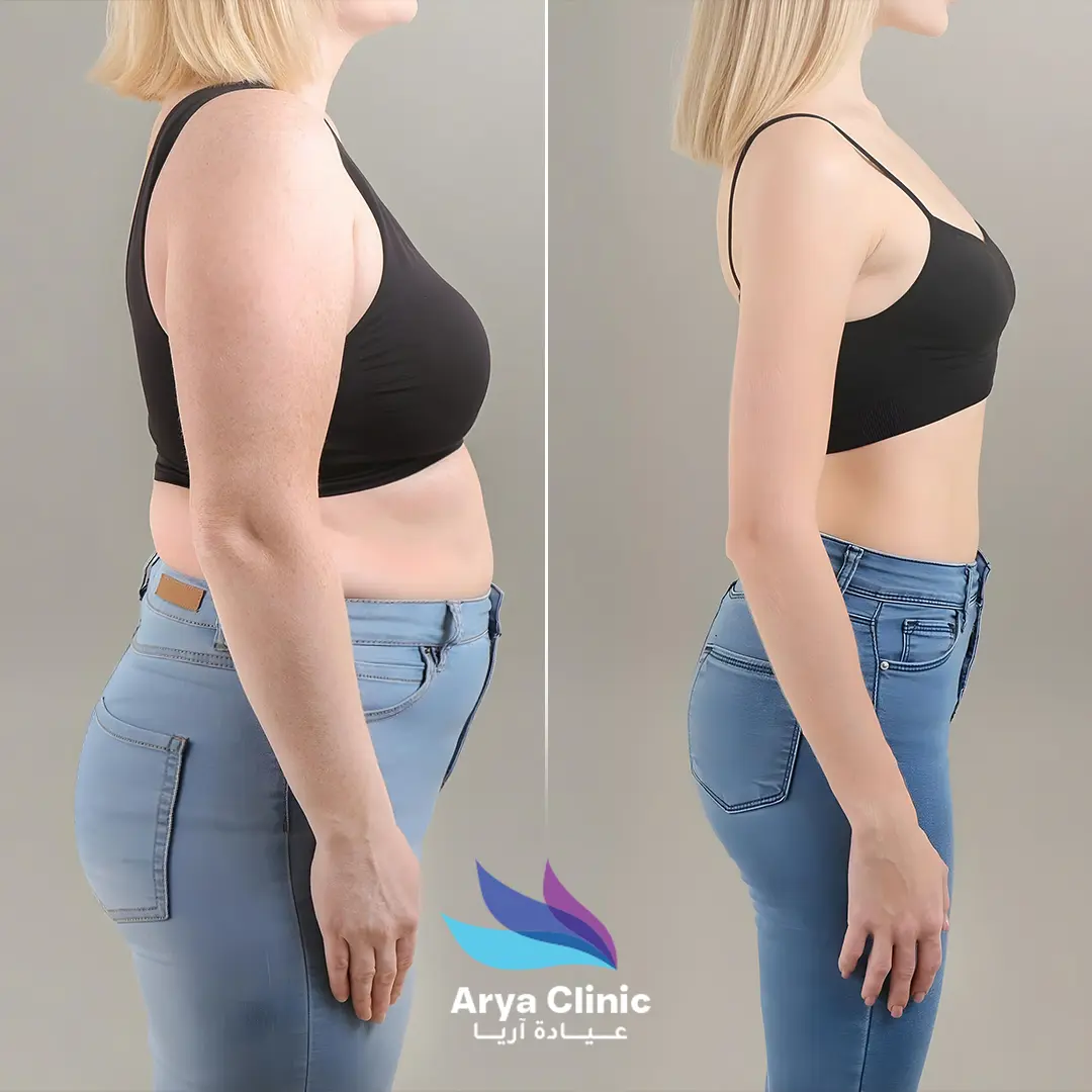liposuction before after result