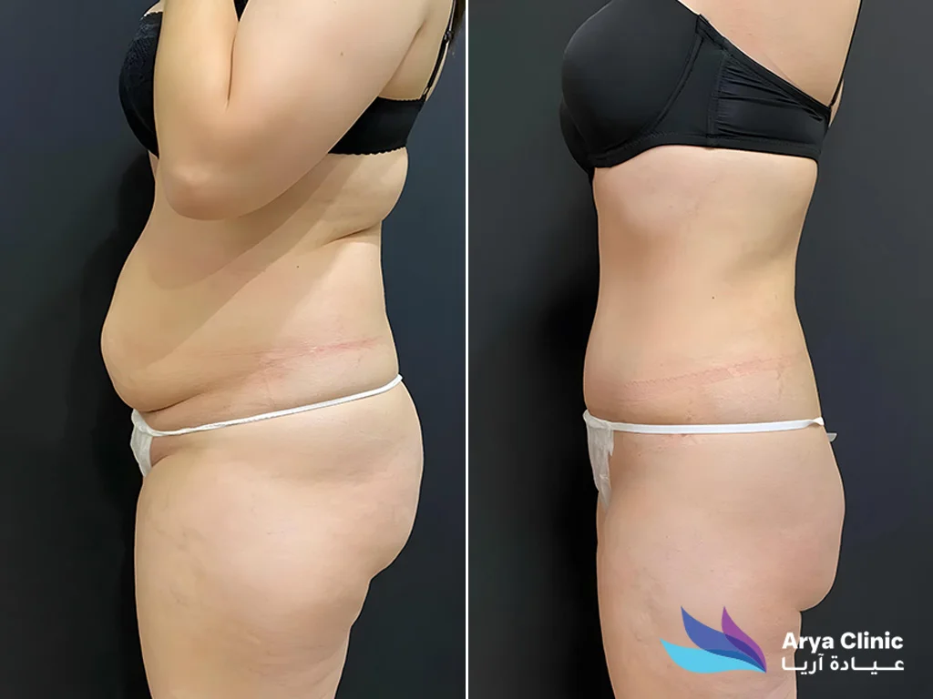 liposuction clinic