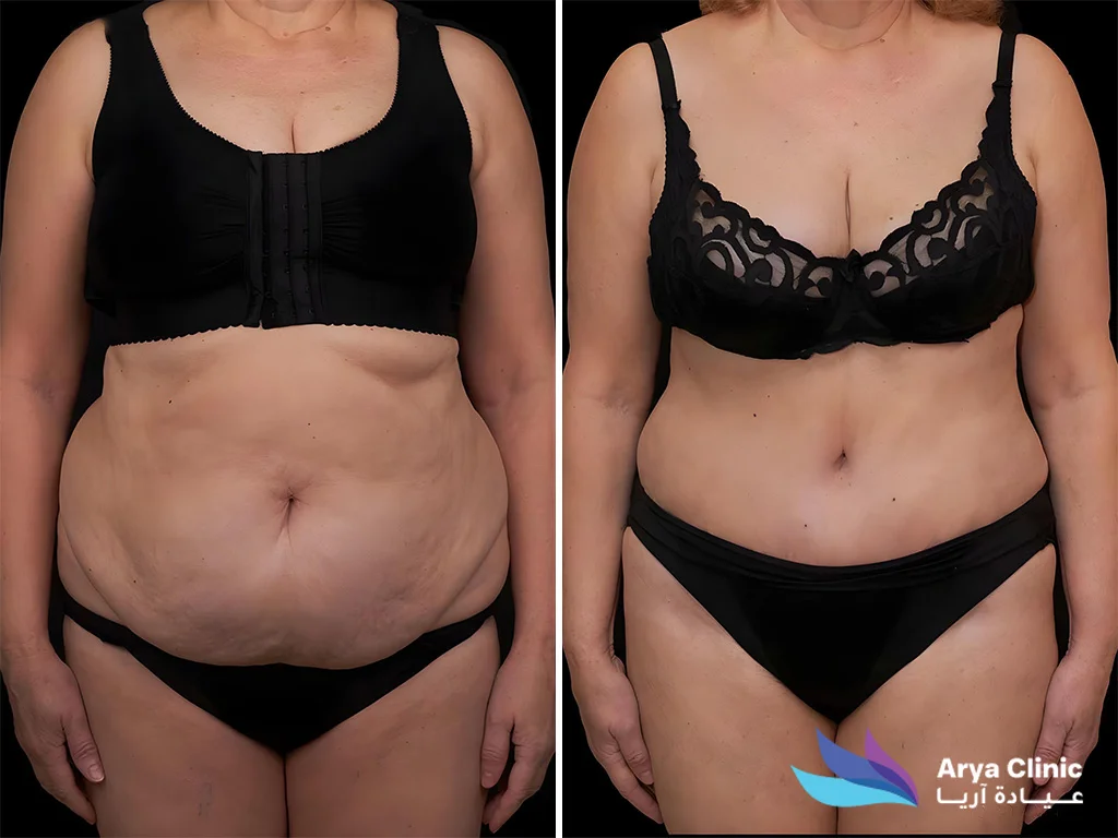 liposuction in dubai