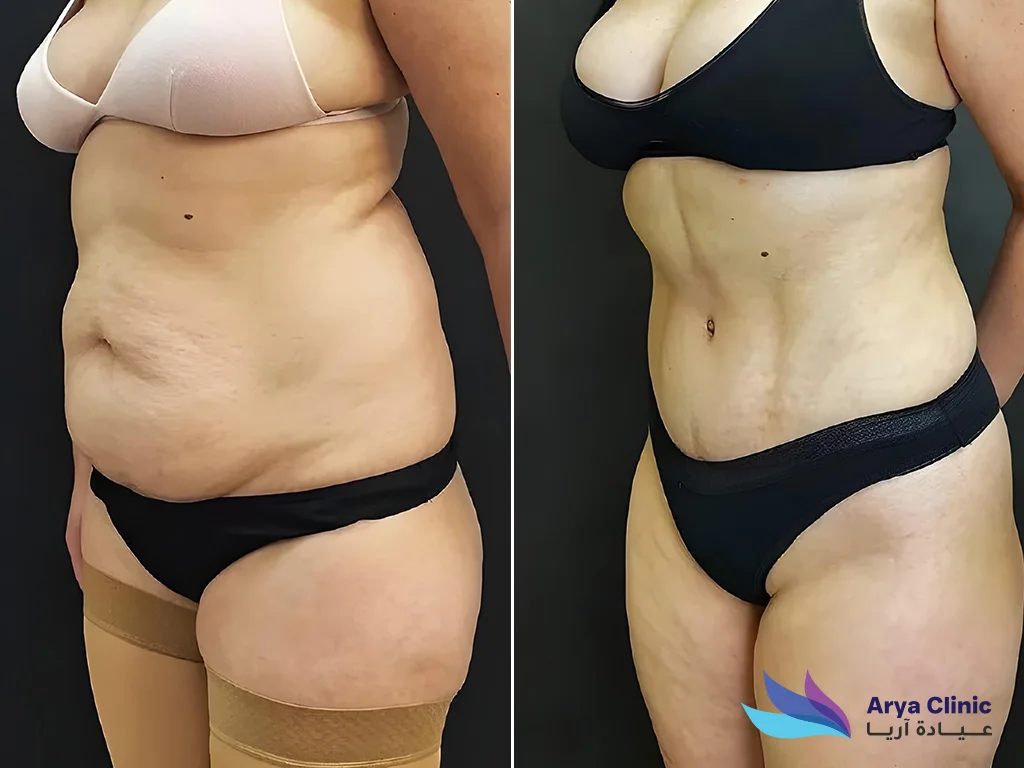 liposuction surgeon