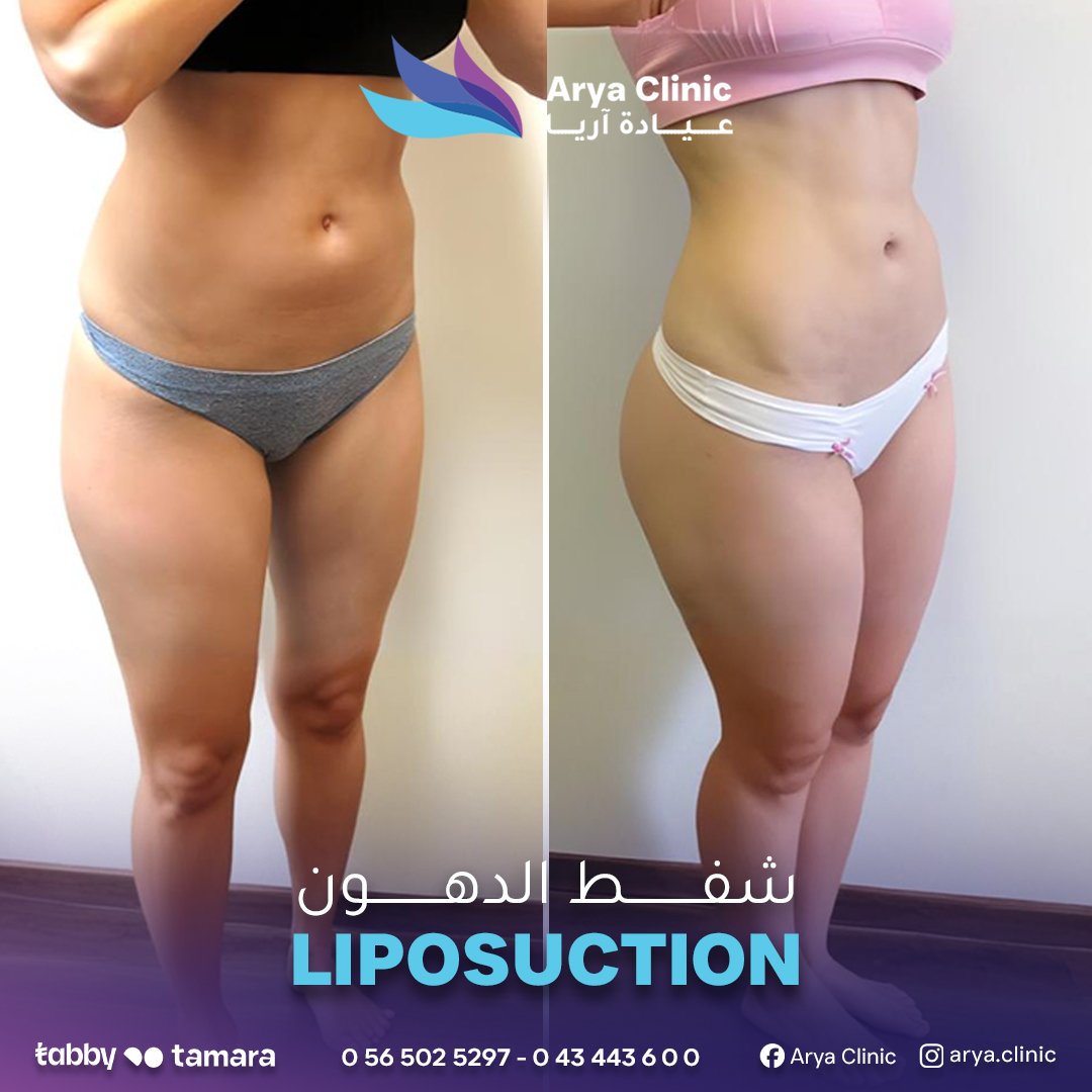 Liposuction 3