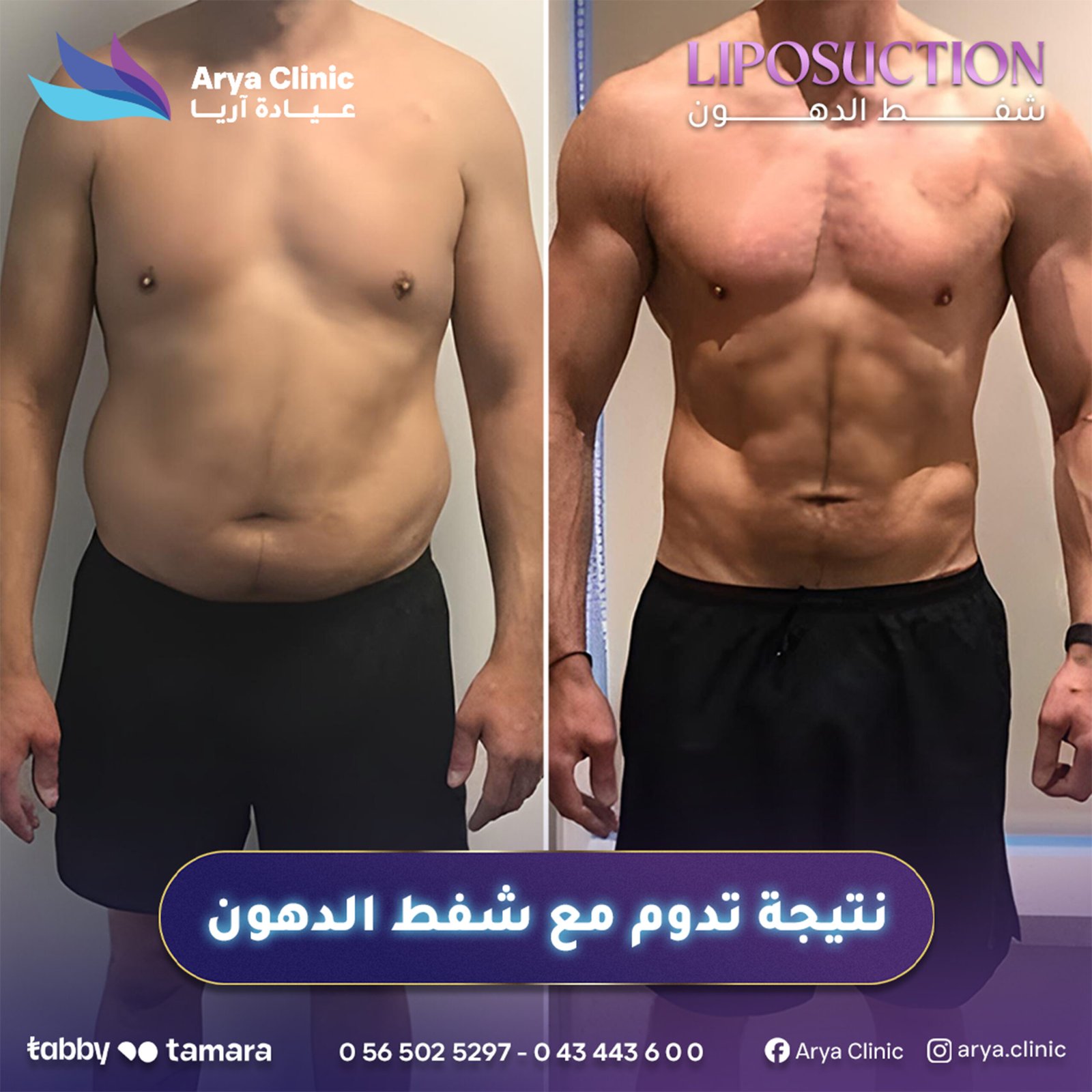 Liposuction 3b