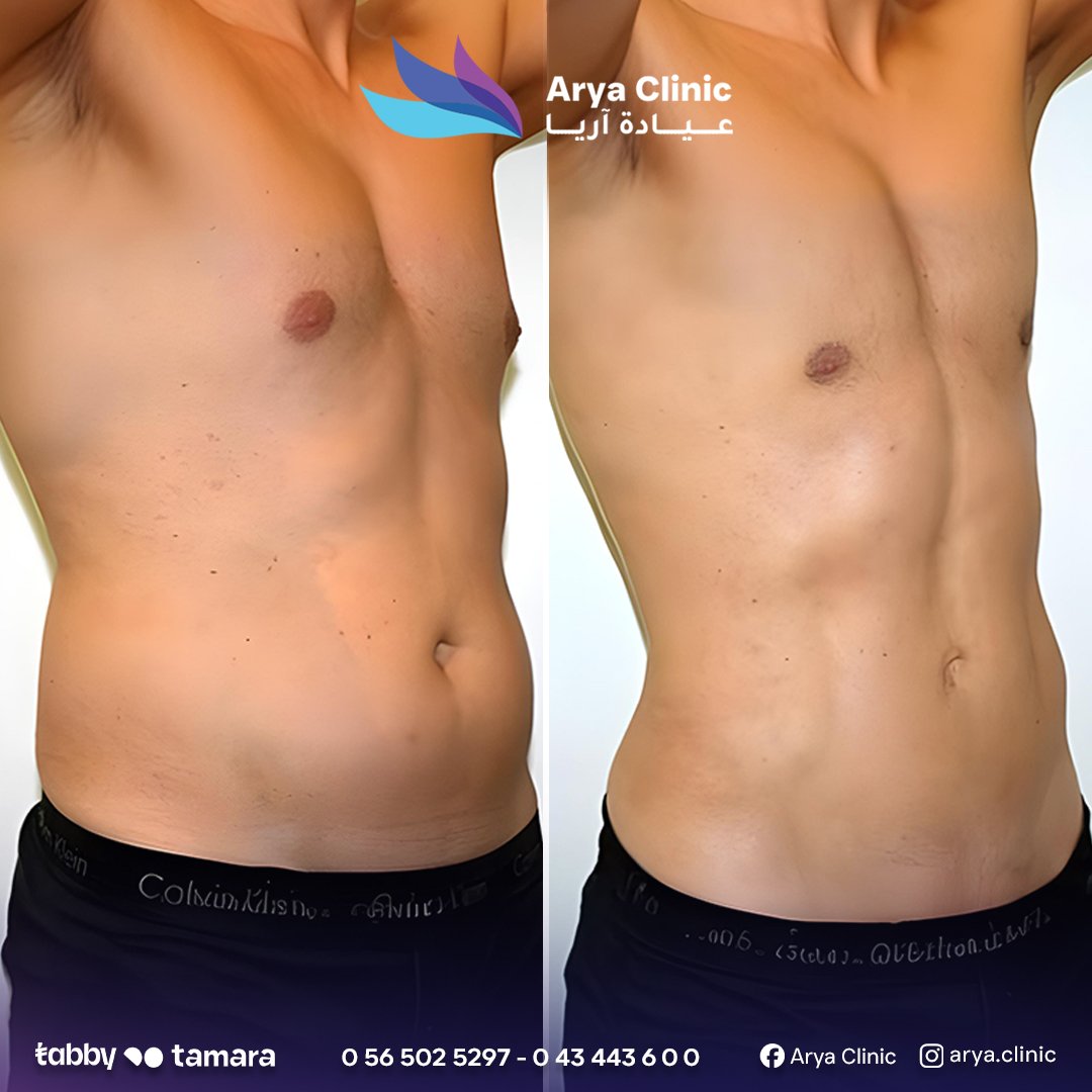 Liposuction 4
