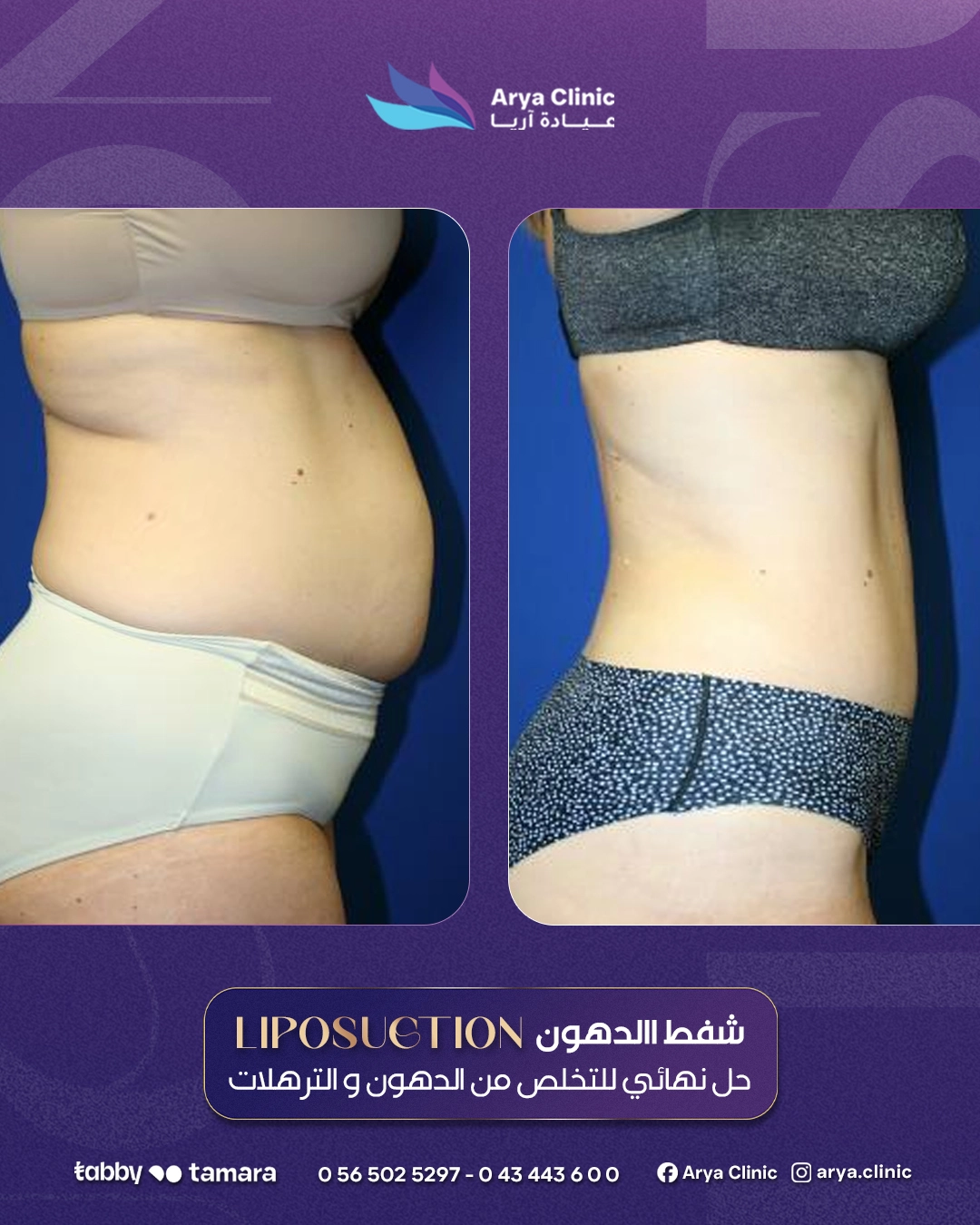 Liposuction 03b