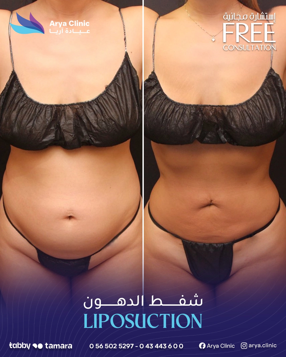 Liposuction 06c