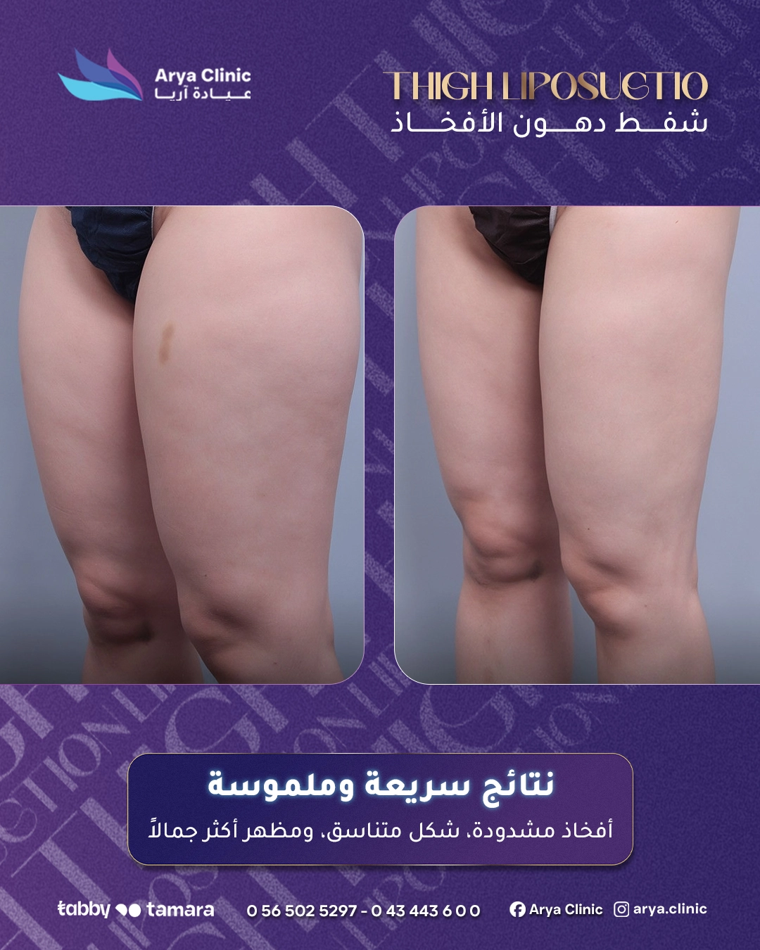 Thigh Liposuction 01b