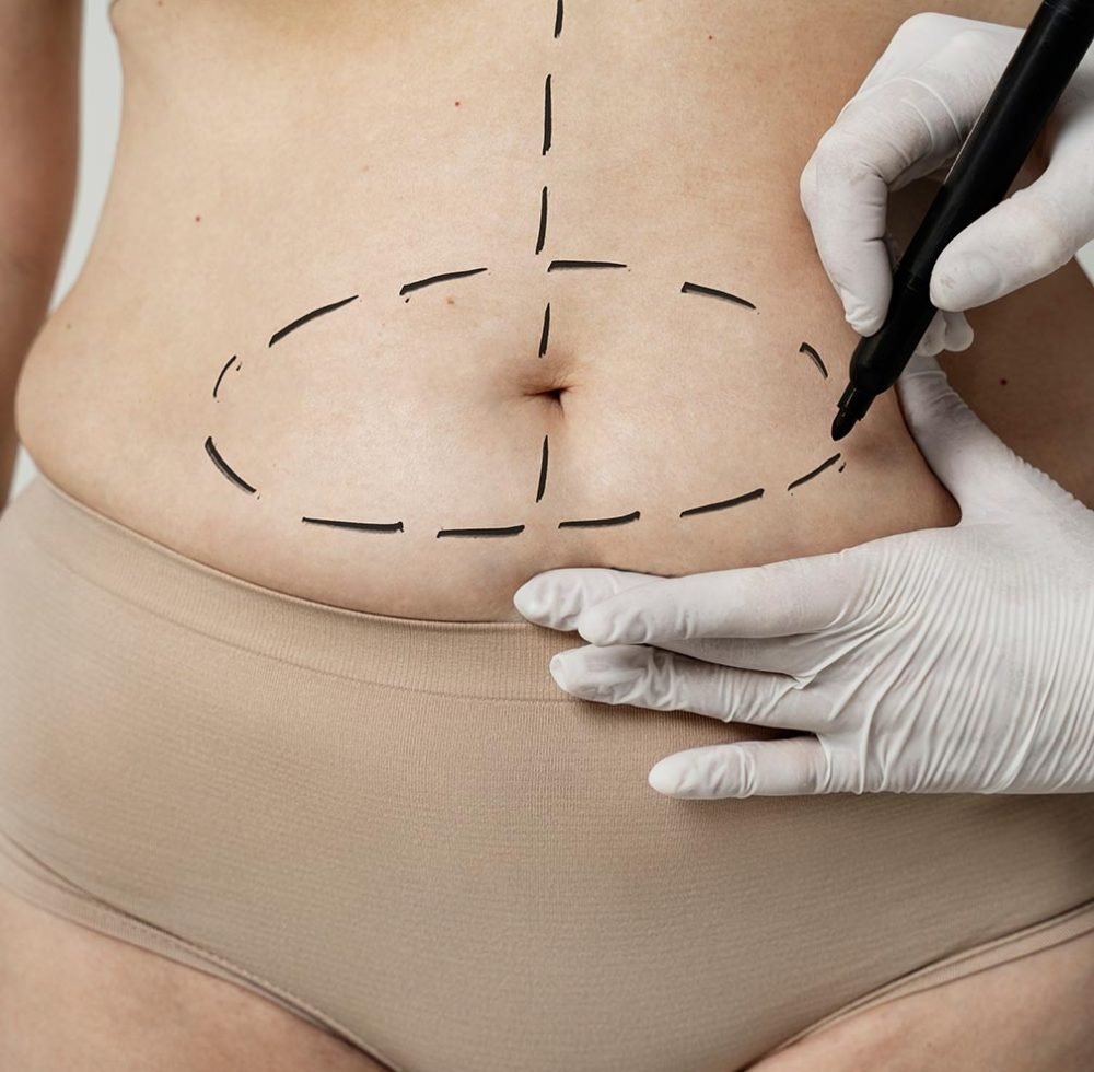 Abdominal Lipo