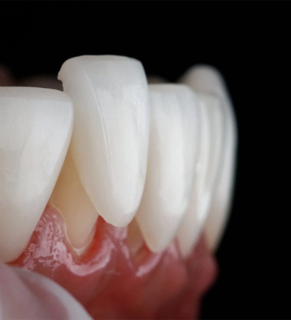 Dental Veneers