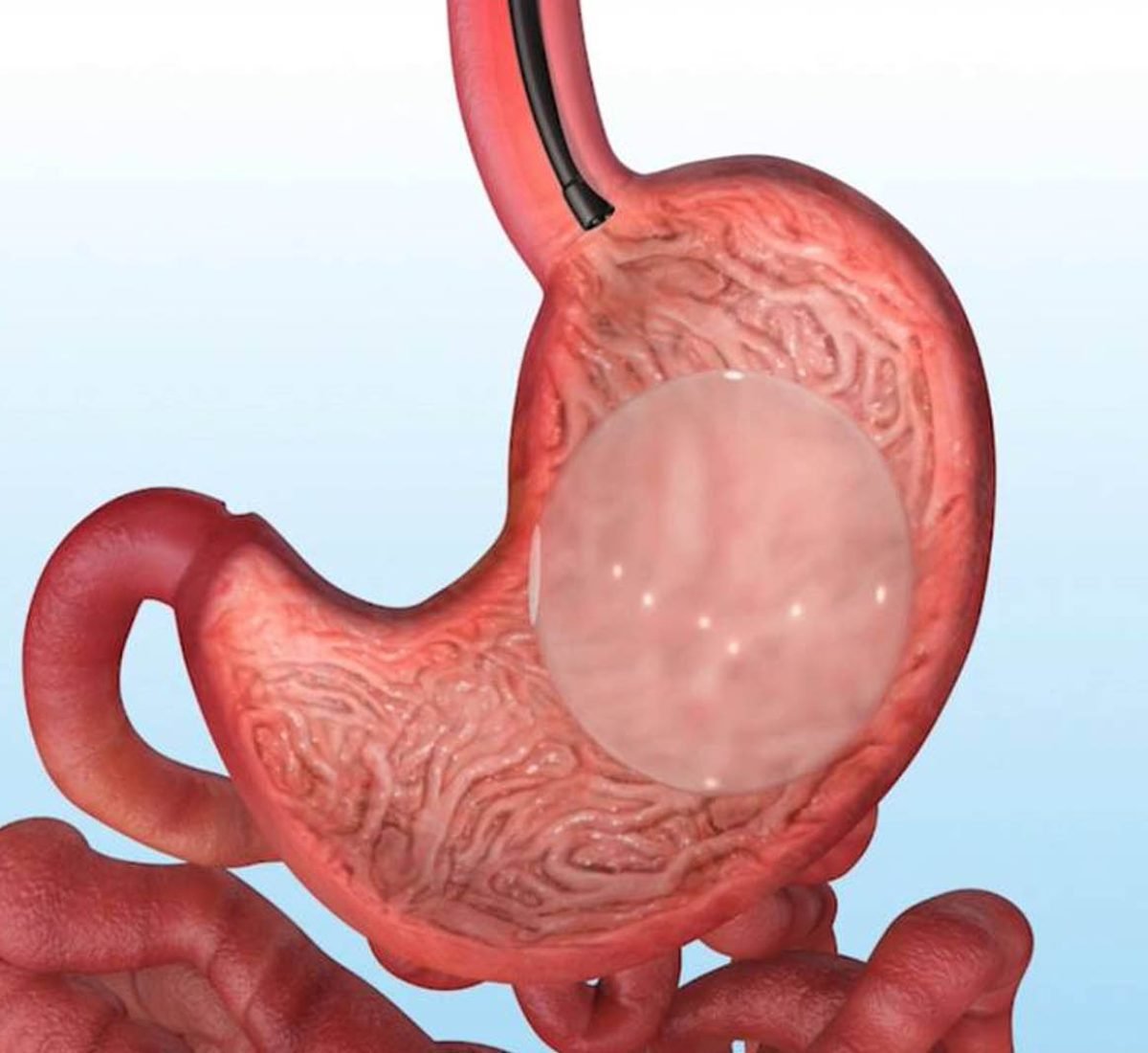 Endoscopic Gastric Balloon
