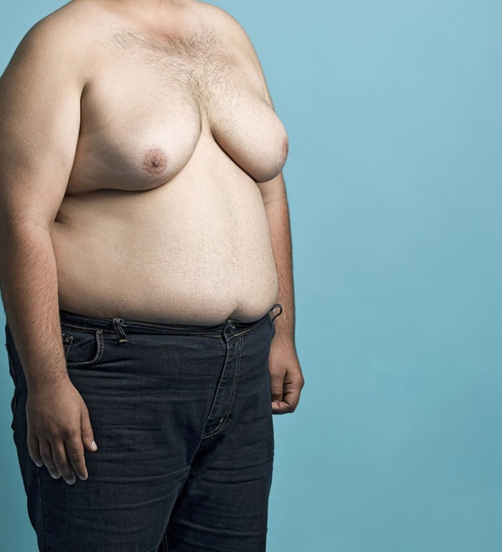 Liposuction for Chest & Abdomen