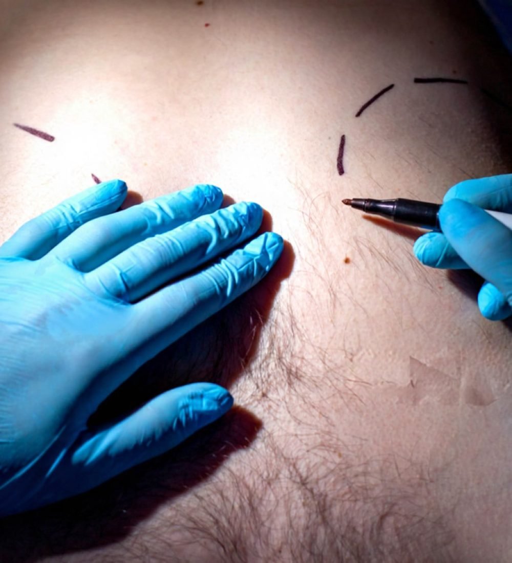 Male Breast Fat Removal