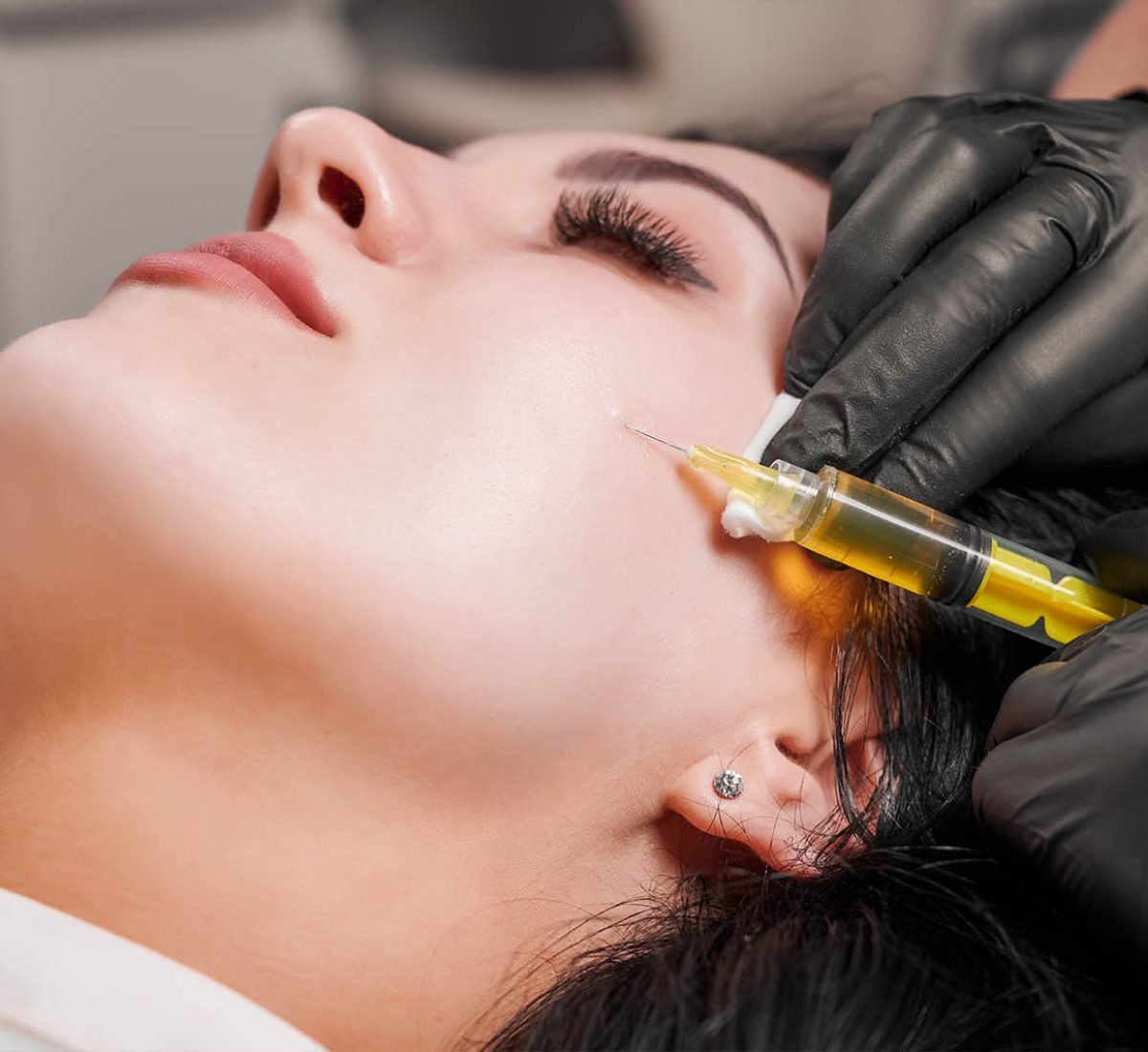 PRP Face Rejuvenation