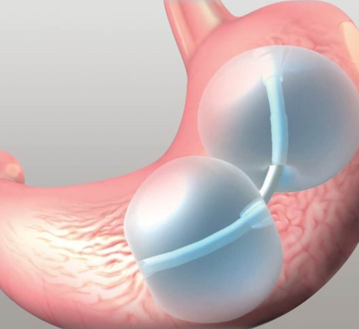 Reshape Gastric Balloon